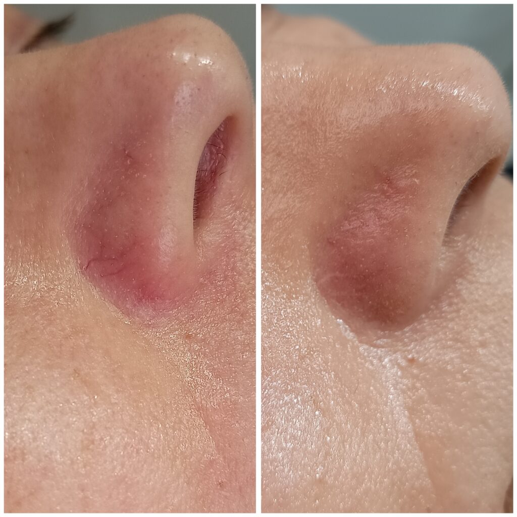 Zamykanie Naczynek  Znamion Rubinowych Bydgoszcz 02